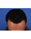 After Hair Transplant&nbsp;Front